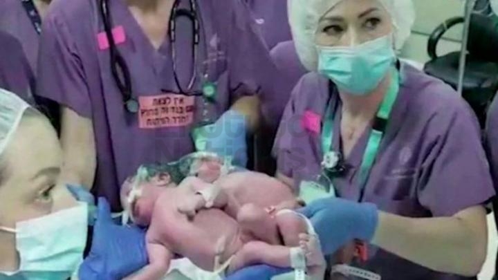 Gemelas unidas por la cabeza pudieron verse por primera vez tras una cirugía que duró 12 horas